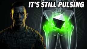 SHOCKING: Army Radar Tech's Hip Implant Beats By Itself 